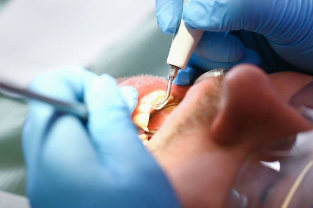 Best Dental Abscess Treatment in New Baltimore, VA