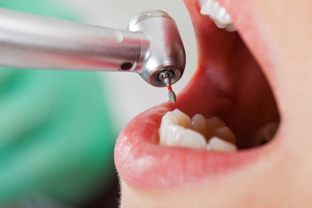 Best Knocked-Out Tooth (Avulsed Tooth) Treatment in New Baltimore, VA
